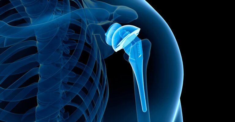 Read more about the article Rottura del legamento collaterale mediale del ginocchio, come capire quando è lesionato o rotto?